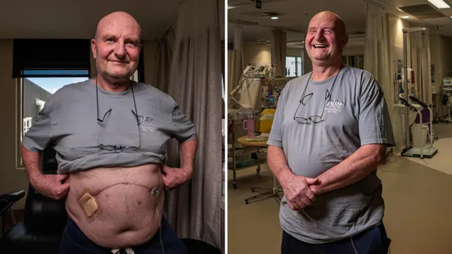 Peter Moulding showing his surgery scar
